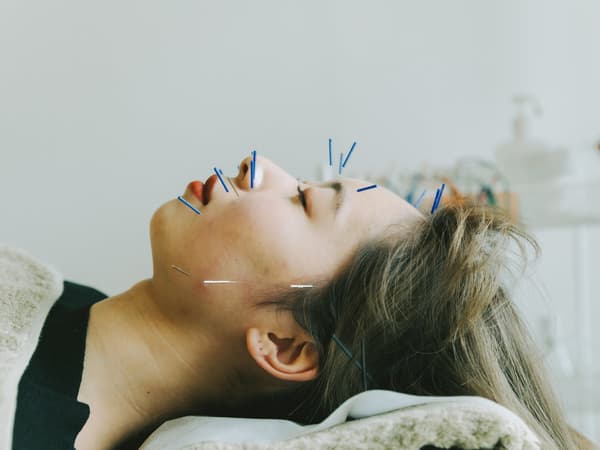 Acupuncture Experience